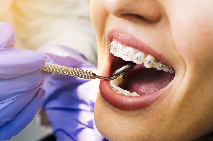 Modern dental braces treatment