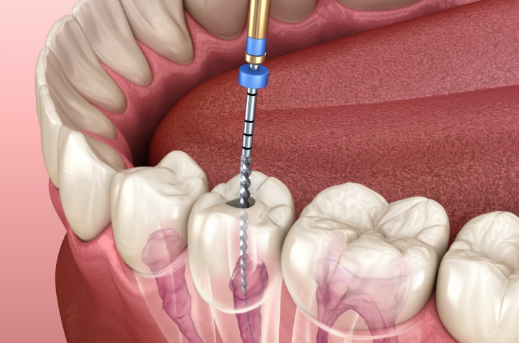 Precision root canal treatment